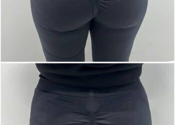 بهترین مرکز تزریق فیلر بادی (باسن+بیکینی) در کرج 💎(قیمت 1404) کلینیک بلا