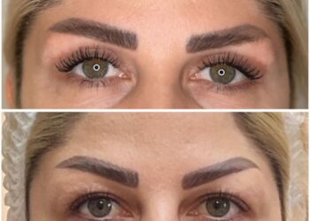 کلینیک بلفاروپلاستی در کرج؛ (جراحی افتادگی پلک +هزینه 1404) ✨