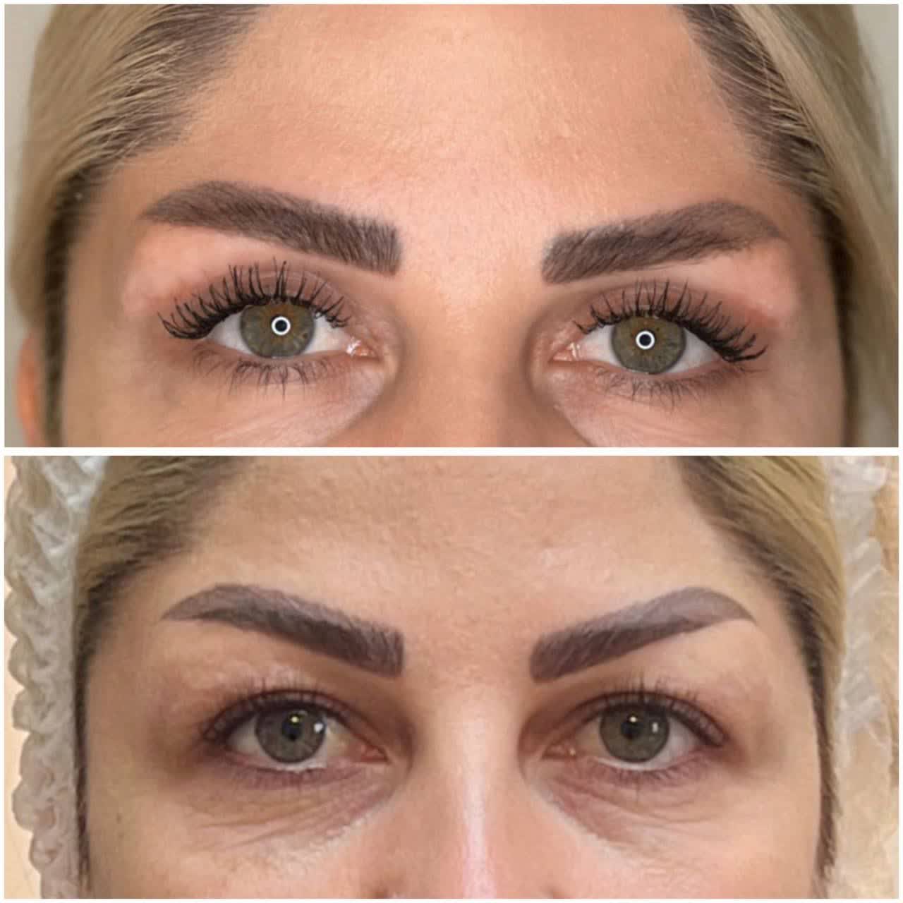 کلینیک بلفاروپلاستی در کرج؛ (جراحی افتادگی پلک +هزینه 1404) ✨