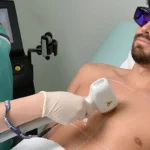 لیزر موهای زائد سینه در آقایان