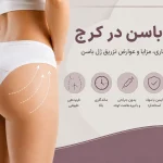 فیلر باسن در کرج